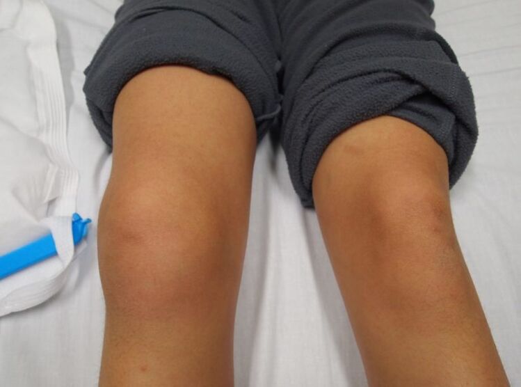 deformidade da articulação do joelho com artrose