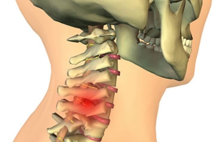 dor no pescoço devido a osteoartrite