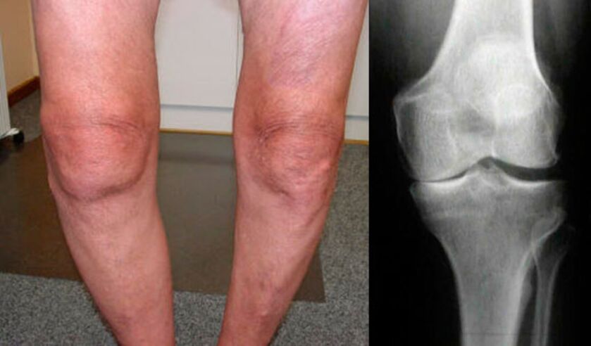 osteoartrite da articulação do joelho