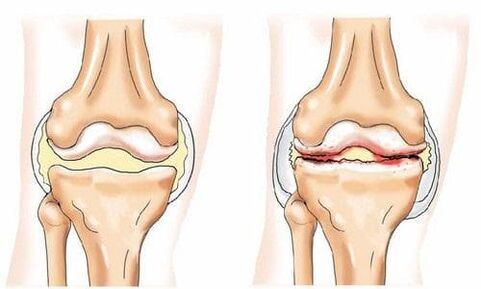 articulação do joelho saudável e artrótica